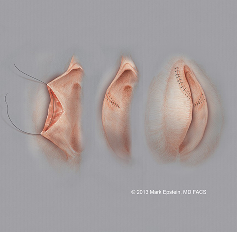 Labiaplasty procedure wedge technique image.